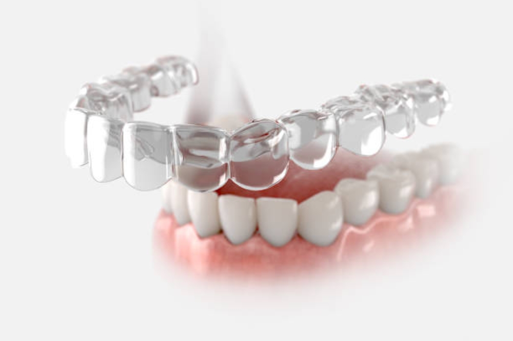 Invisalign Process Explained: From 3D Scan to Final Results